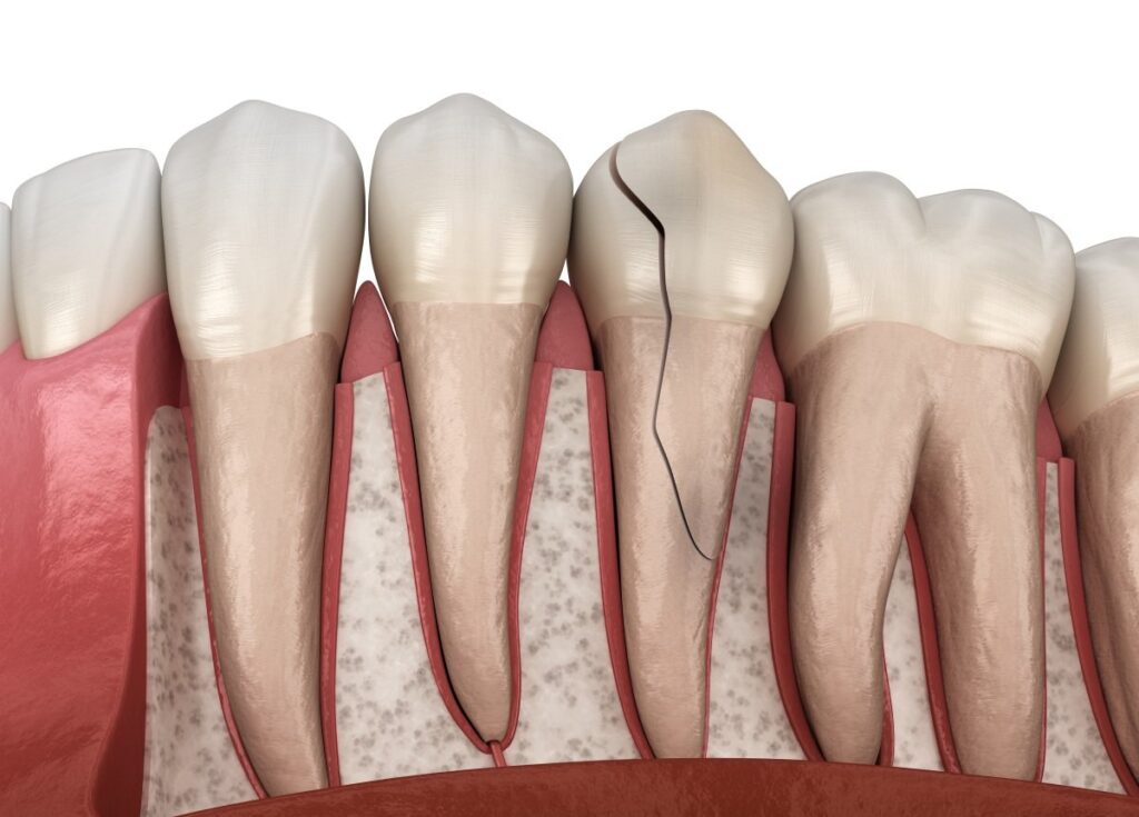 Broken Or Knocked-Out Tooth Near You