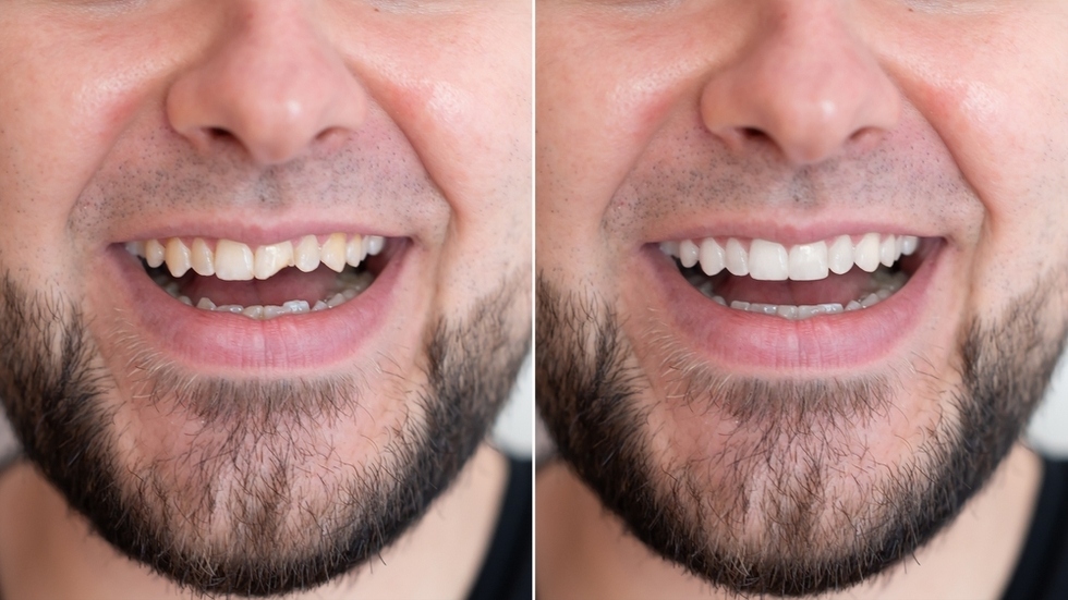 Chipped or Fractured Teeth Repair in SW Calgary, AB