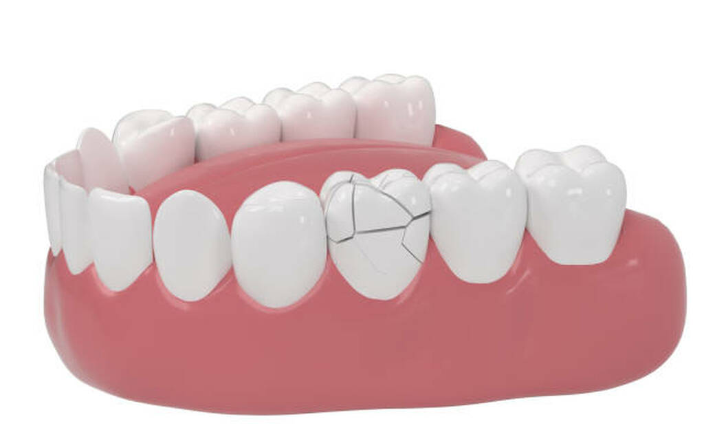 Chipped or Fractured Teeth Repair Near You