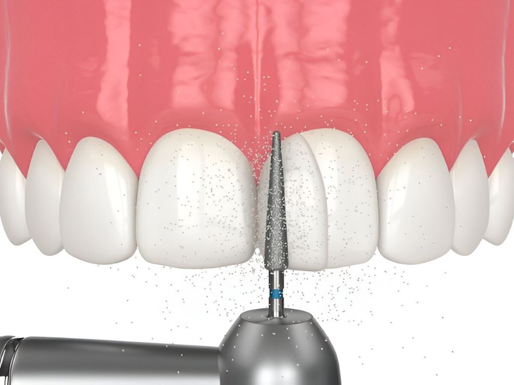 Dental Bonding in SW Calgary, AB