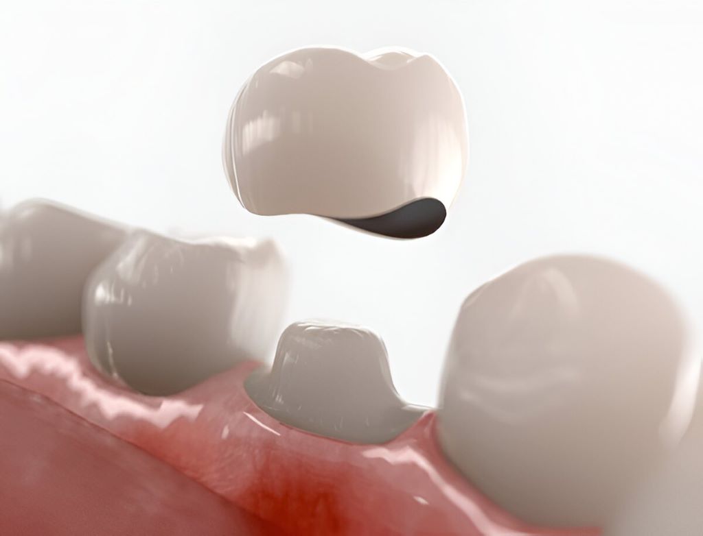 Dental Crowns Near You
