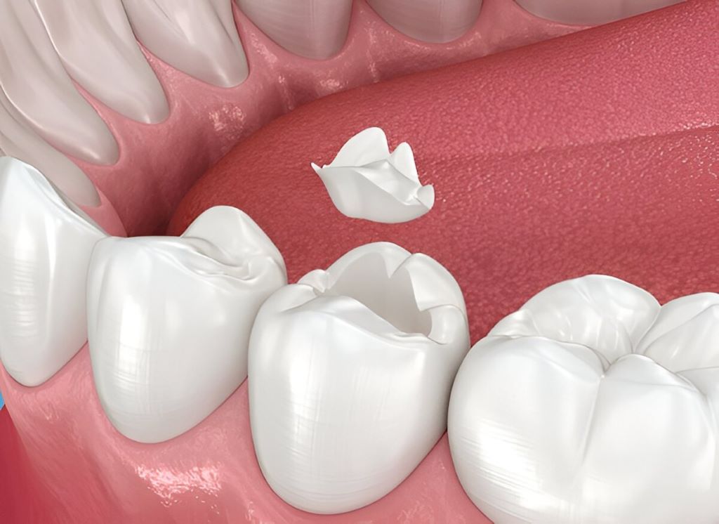 Dental Inlays & Onlays in SW Calgary, AB