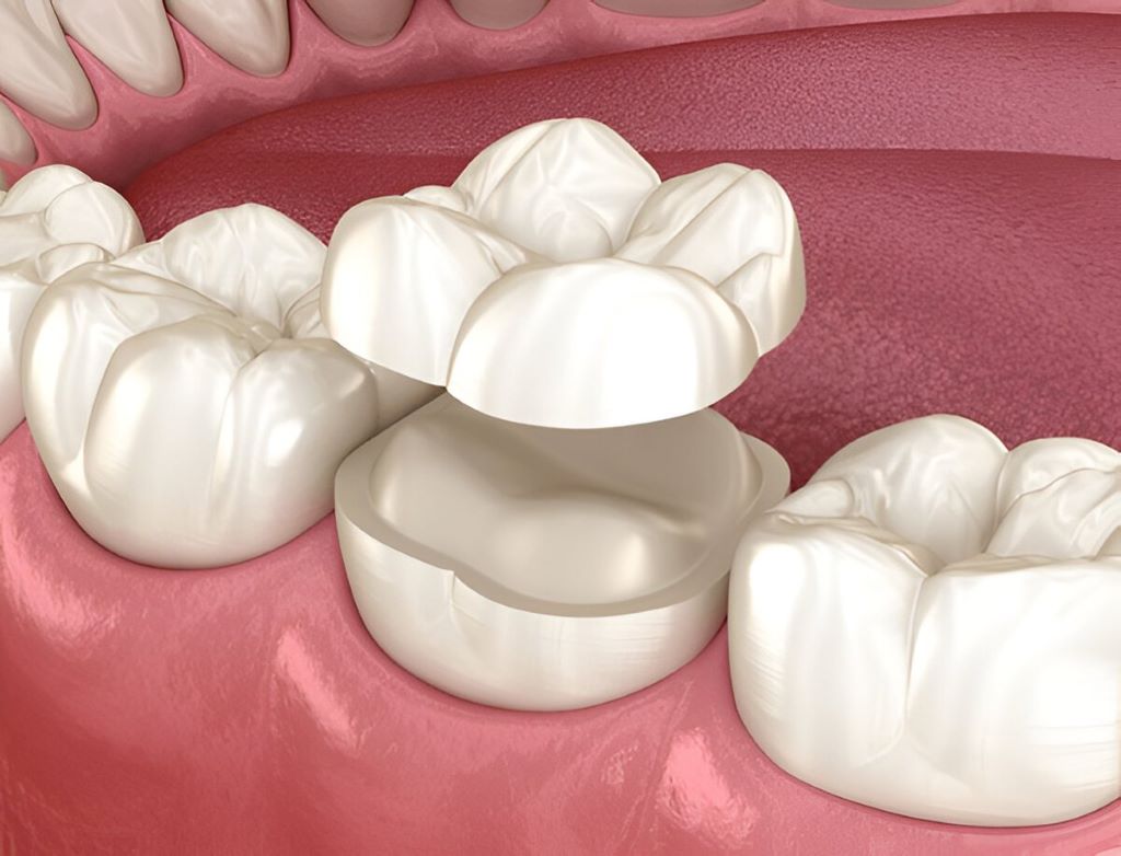 Dental Inlays & Onlays Near You