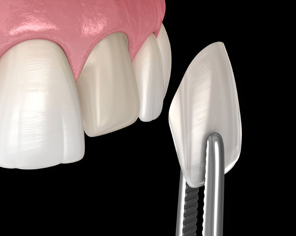 Dental Veneers Near You