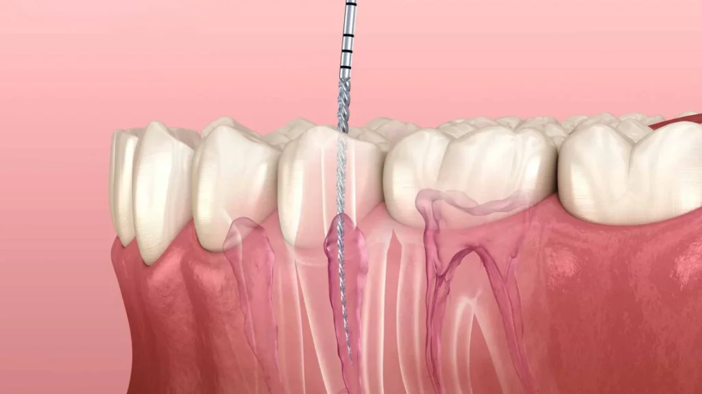 Emergency Root Canal in SW Calgary