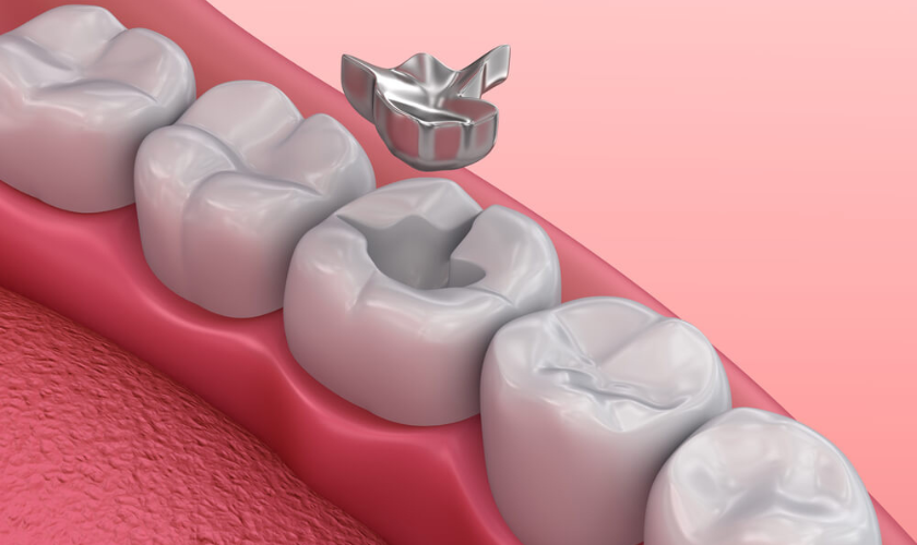 Lost or Loose Fillings & Crowns in SW Calgary