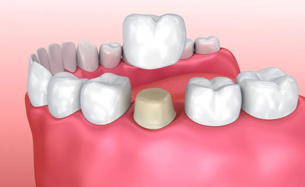 Lost or Loose Fillings & Crowns Near You