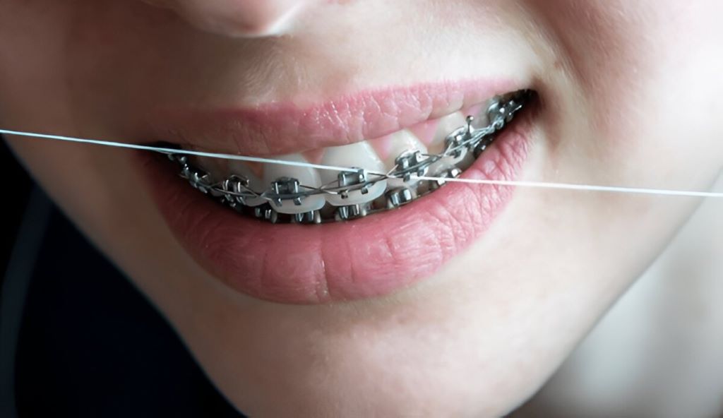 Orthodontic Maintenance in SW Calgary, AB