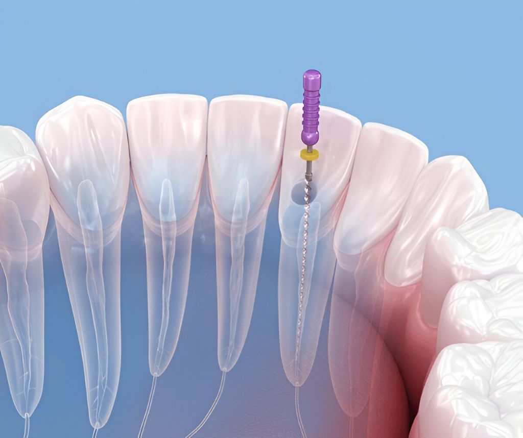 Root Canal Therapy in SW Calgary, AB