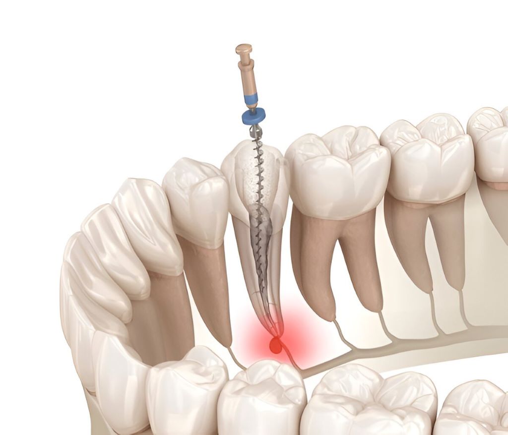 Root Canal Therapy Near You