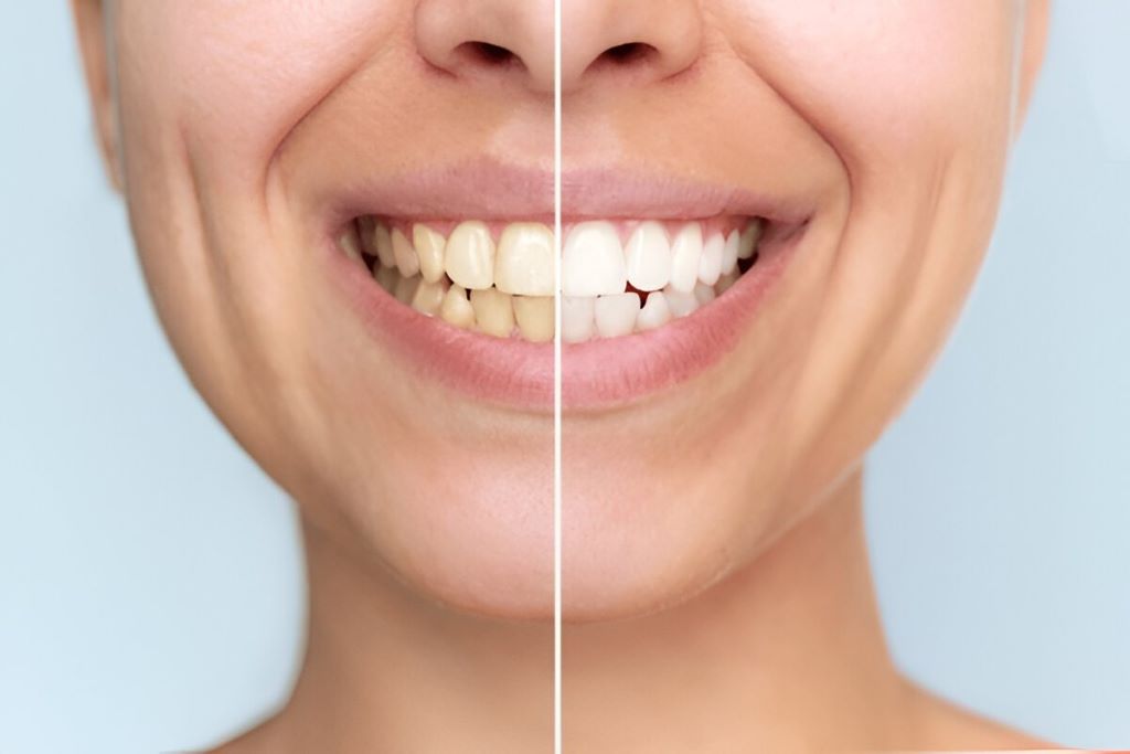 Teeth Whitening in SW Calgary, AB
