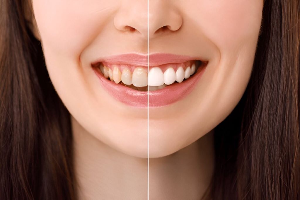 Teeth Whitening Near You