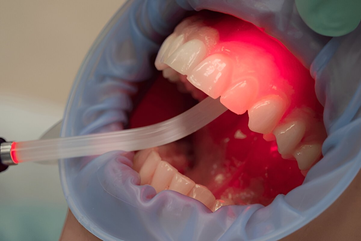 dental laser therapy for hygiene near you