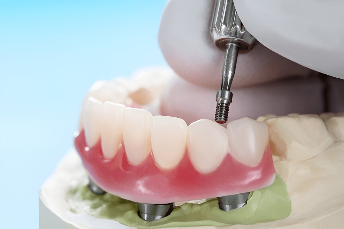 implant-supported dentures in sw calgary