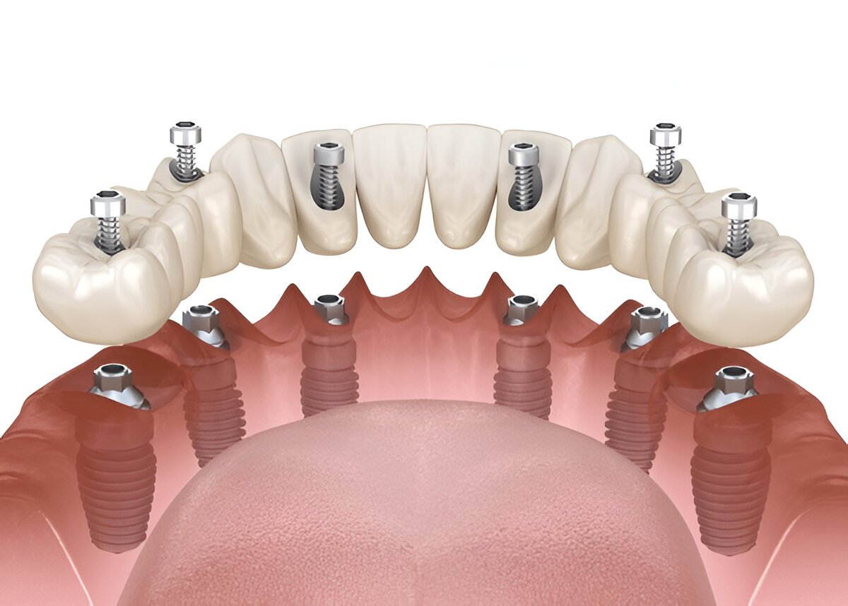 implant-supported dentures near you