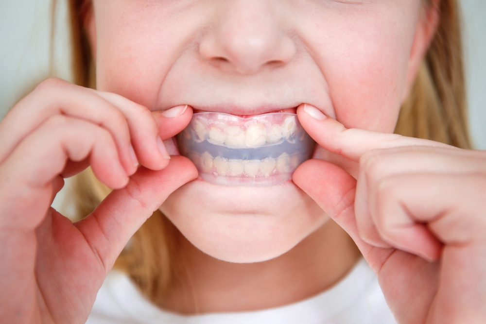 mandibular advancement devices near you