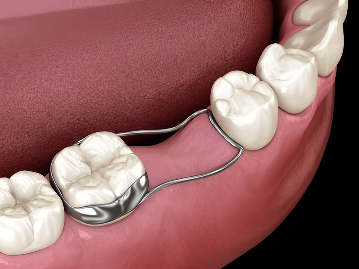 partial dentures in sw calgary
