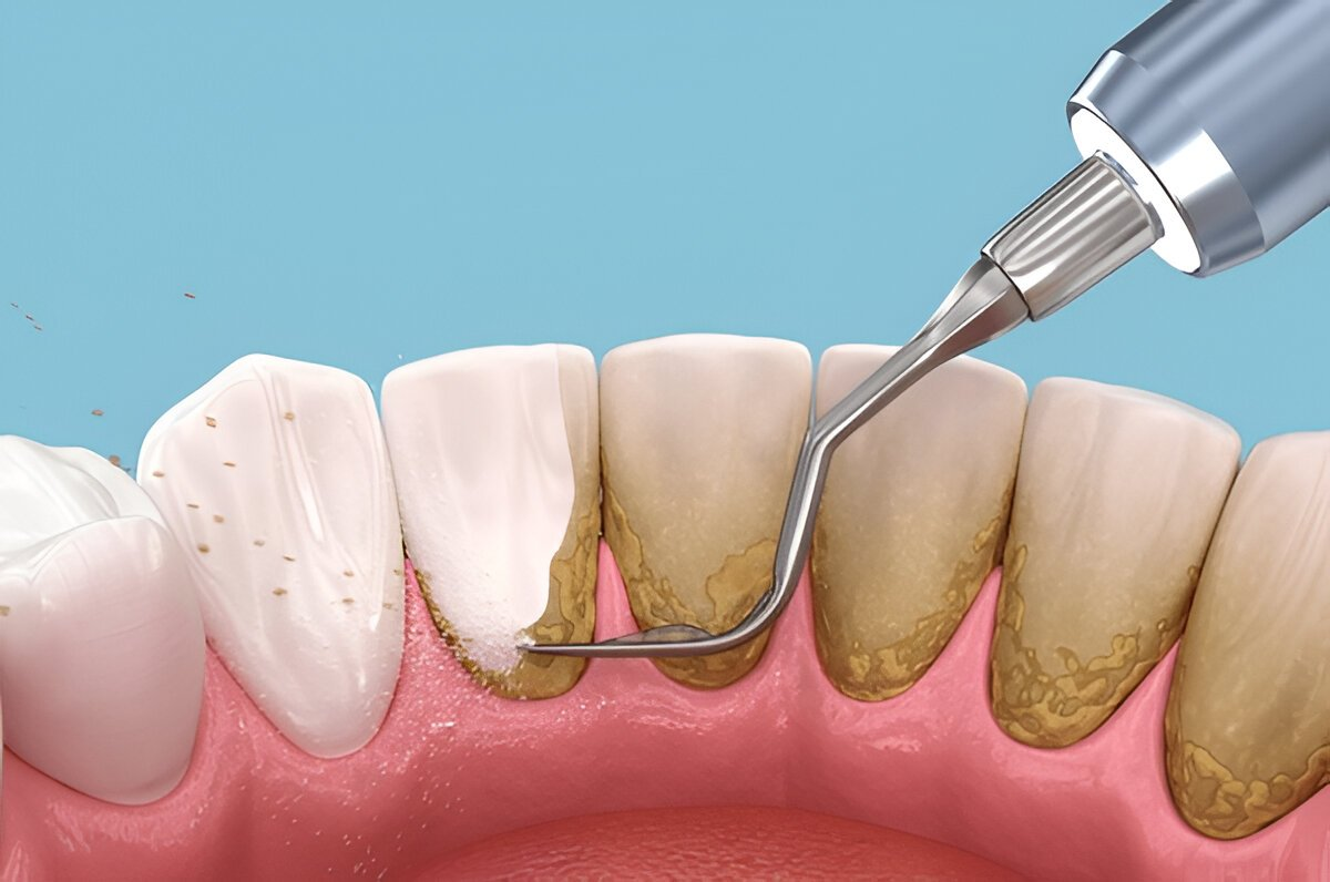 Periodontal Therapy Near You