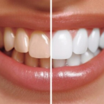 Safe Teeth Whitening Methods for Sensitive Teeth